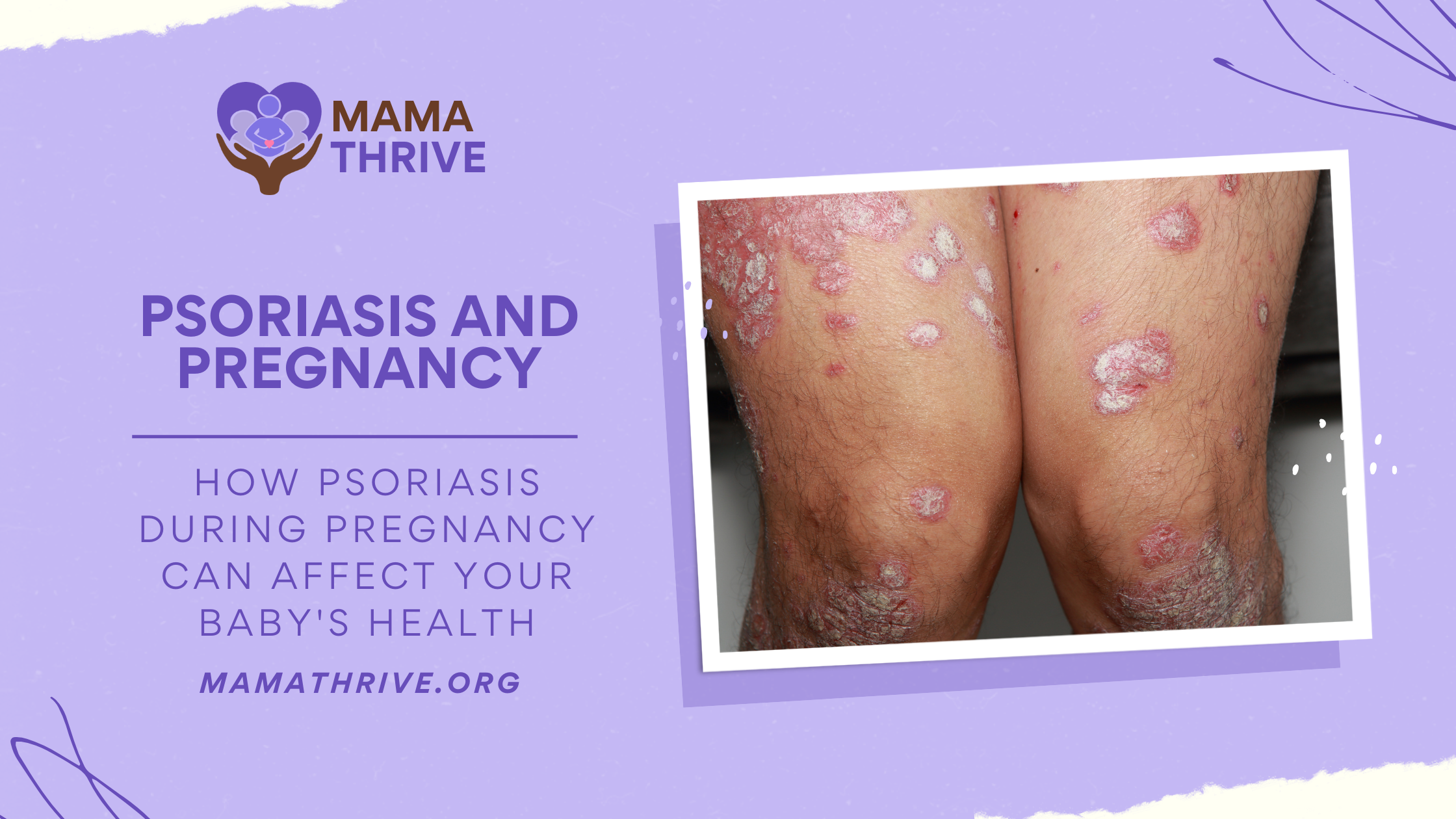 How Psoriasis During Pregnancy Can Affect Your Baby's Health blog